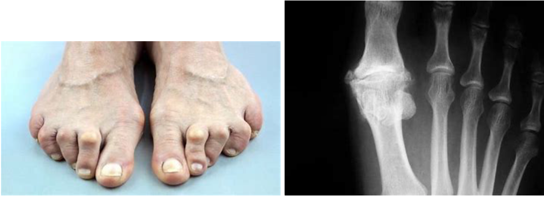 Arthritis-of-the-foot-and-ankle-podiatry-of-arlington-heights.webp