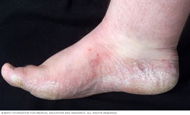 Athletes-foot-treatment-tinea-pedis-maccasin-distribution.webp