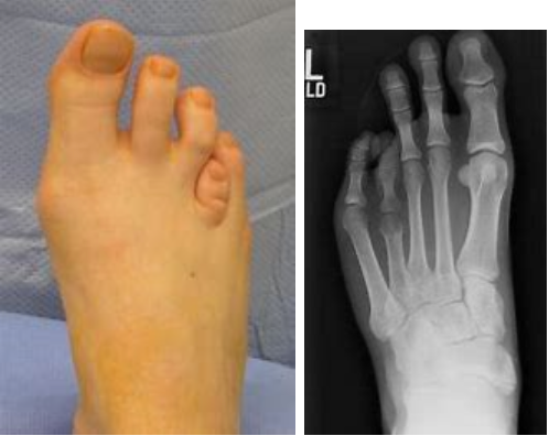Brachymetatarsia-podiatry-of-arlington-heights