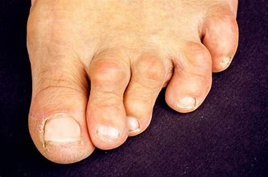 Hammertoe-treatment-podiatry-of-arlington-heights