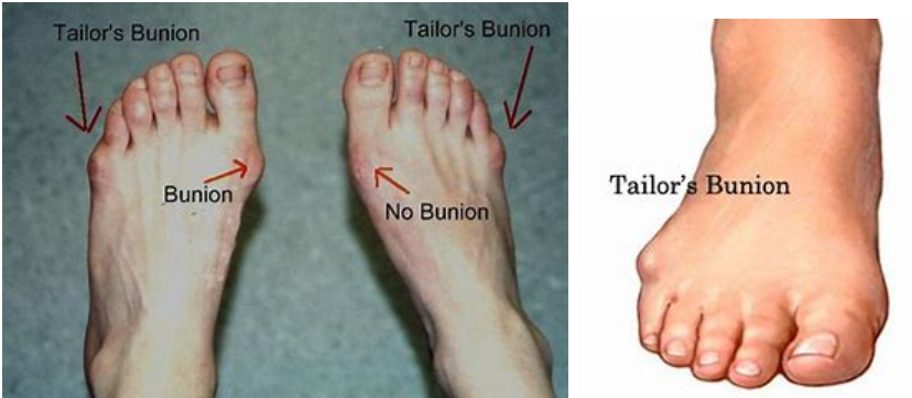 Tailors-Bunion-podiatry-of-arlington-heights.webp