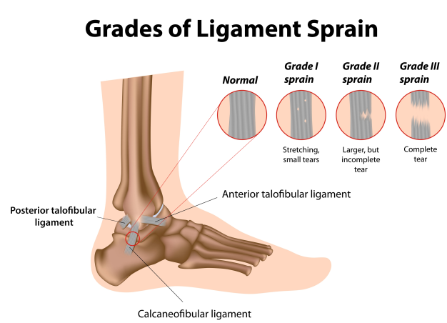 ankle-sprain-treatment-podiatry-of-arlington-heights