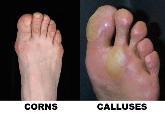 corns-and-callus-treatment-podiatry-of-arlington-heights.webp