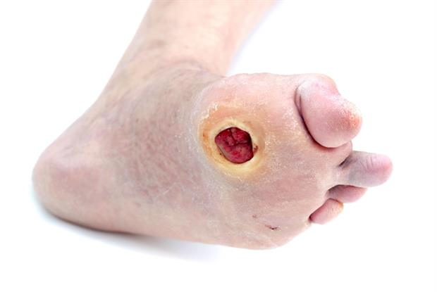 diabetic-foot-wound-care-diabetic-foot-ulceration.webp