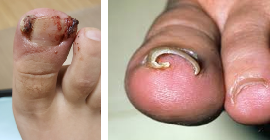 ingrowntoenail-1.webp