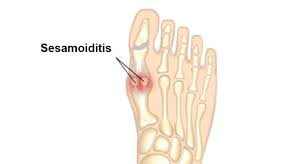 sesamoiditis.webp