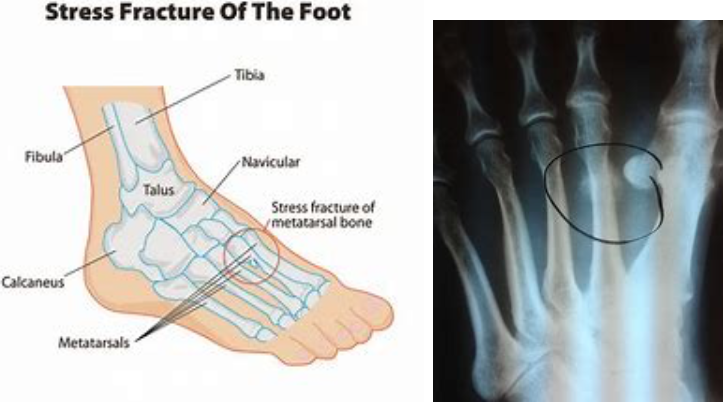 stress-fracture-of-the-foot-podiatry-of-arlington-heights.webp