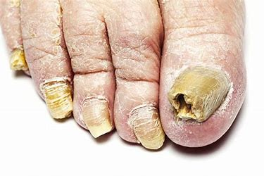 toenail-fungus-treatment-podiatry-of-arlington-heights-2.webp