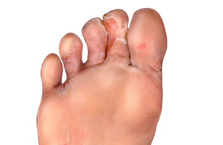Athletes-foot-treatment-tinea-pedis-interdigital
