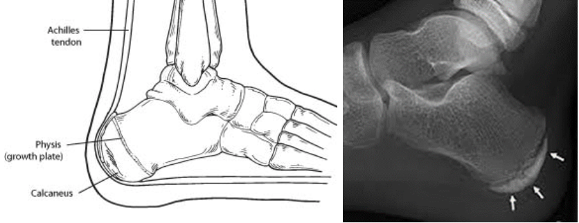 Podiatry-of-arlington-heights-clcaneal-apophysitis