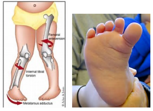 in-toeing-pigeon-toed-podiatry-of-arlington-heights