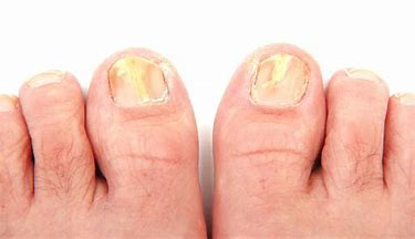toenail-fungus-treatment-podiatry-of-arlington-heights